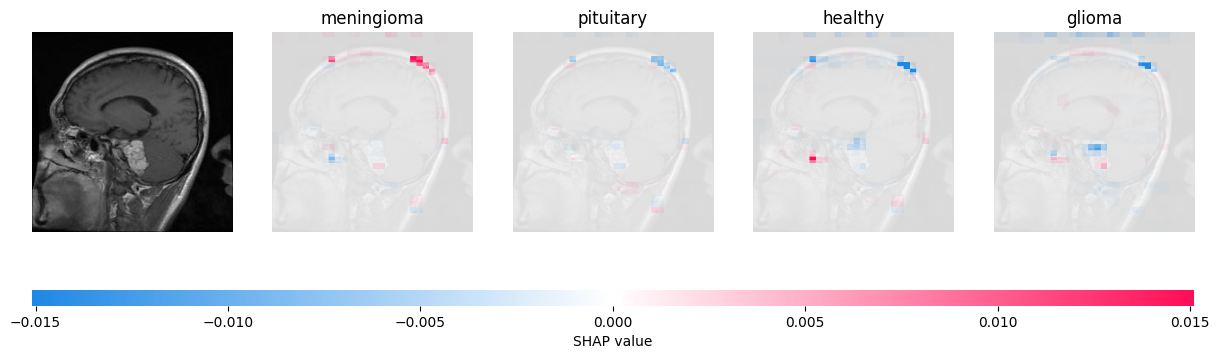 Top guesses of the model Meningioma-positive Brain Scan