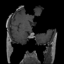The anchor for the brain scan. Figure 4
